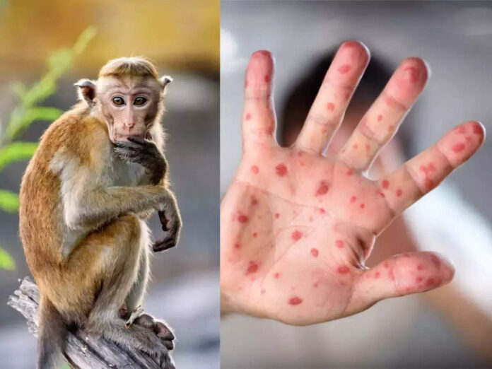 Monkey Pox becomes a global threat!