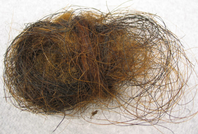 UP woman complains of severe stomach ache, doctors remove 2-kg hairball